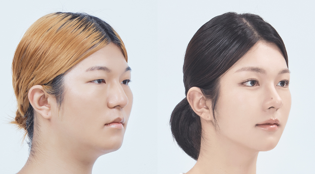 facial-fillers-vs-jaw-fillers-korea-seoul