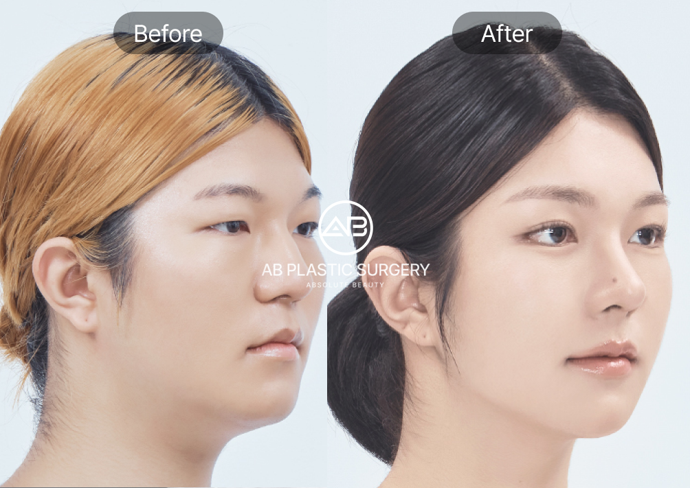 flat-nose-enhancement-korean-rhinoplasty-nose-job-seoul