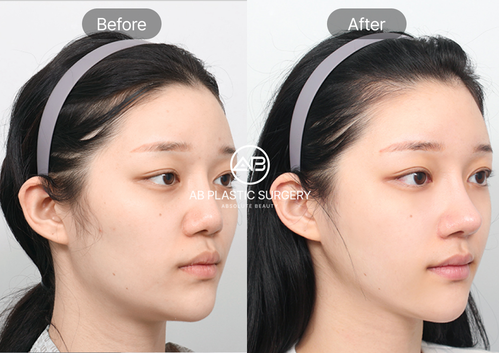 implant-free-rhinoplasty-seoul-korea