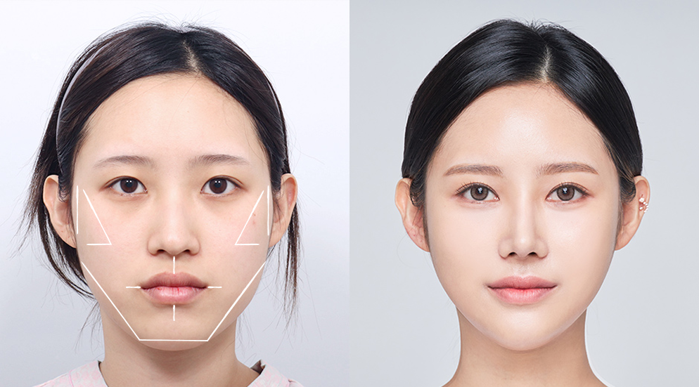 jaw-contouring-vs-fillers-in-korea-seoul