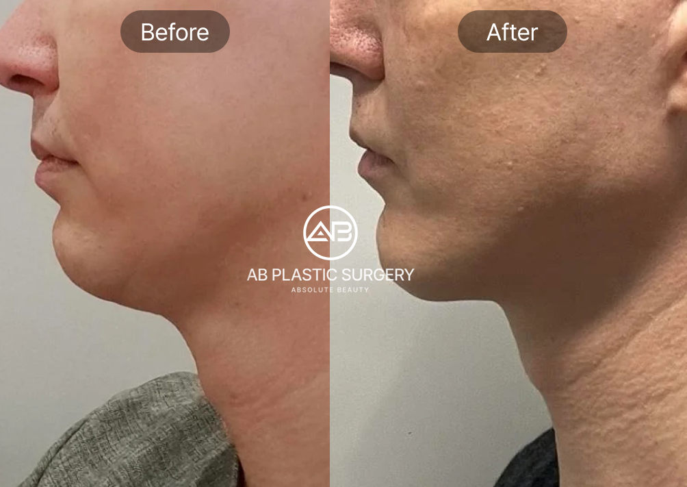 jaw-sculpting-for-men-in-korea-seoul