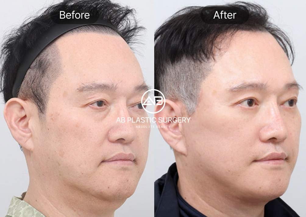 korean-facelift-for-anti-aging-for-men-before-after