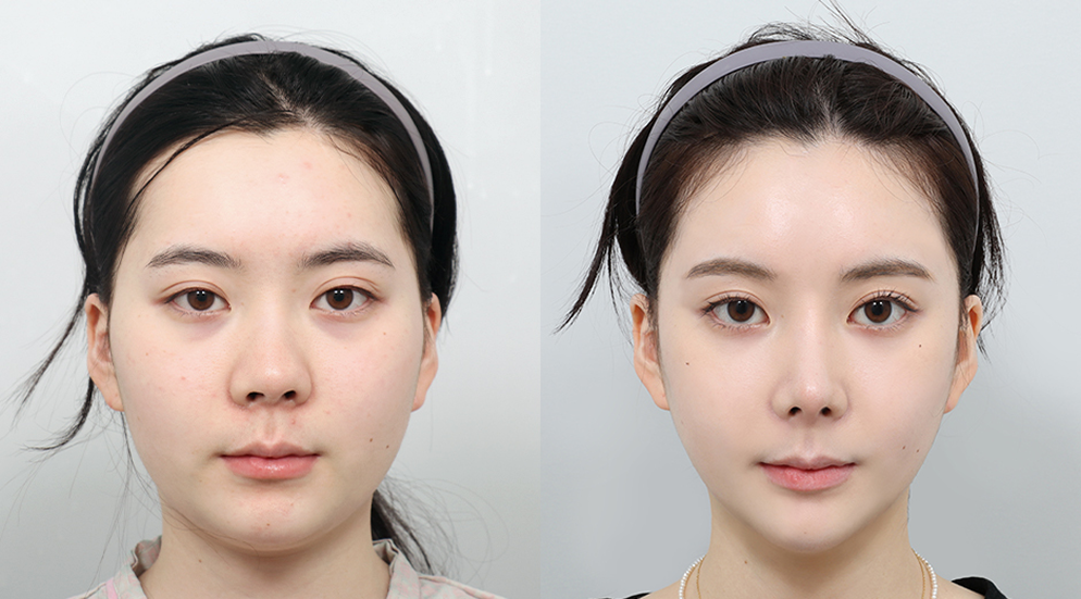 korean-jaw-contouring-vs-jaw-fillers