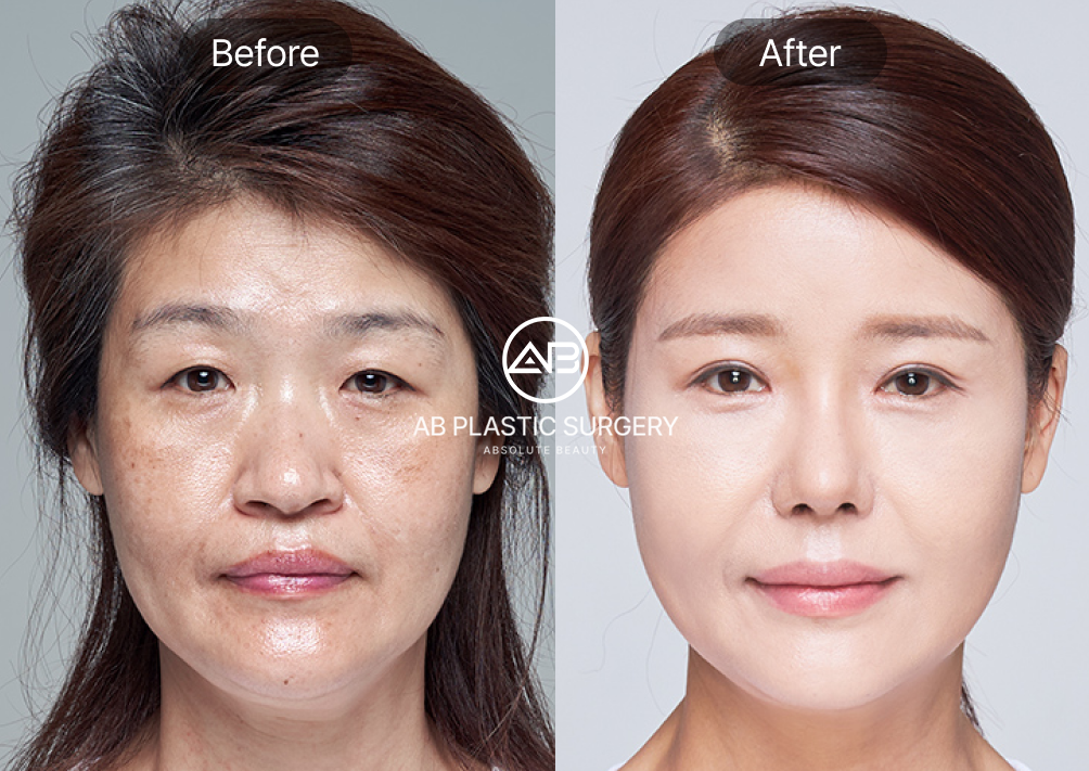 middle-age-rhinoplasty-seoul-korea-nose-job