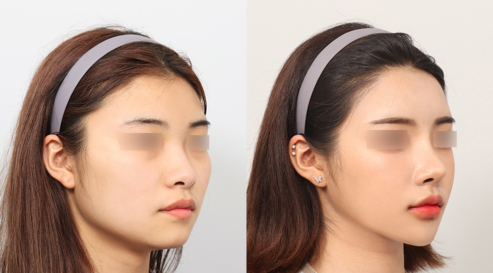 square-jaw-reduction-contouring-surgery-korea-seoul