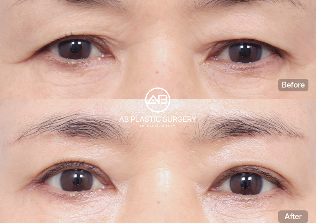 upper-blephatoplasty-for-anti-aging-korea-seoul-before-after