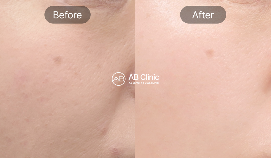 acne-treatment-in-korea-korean-beauty-treatments-in-seoul