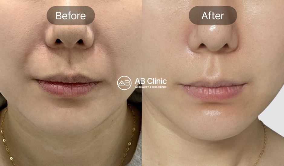 anti-aging-beauty-treatments-in-korea-results