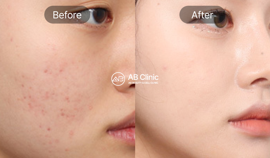 beauty-skin-treatments-in-korea-seoul-before-after