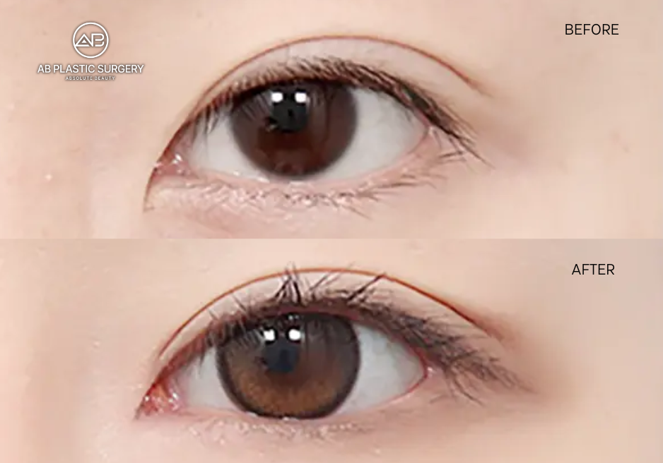 canthoplasty-for-almonf-shape-eyes
