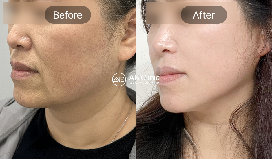 effect-of-the-stem-cell-therapy-korea-seoul