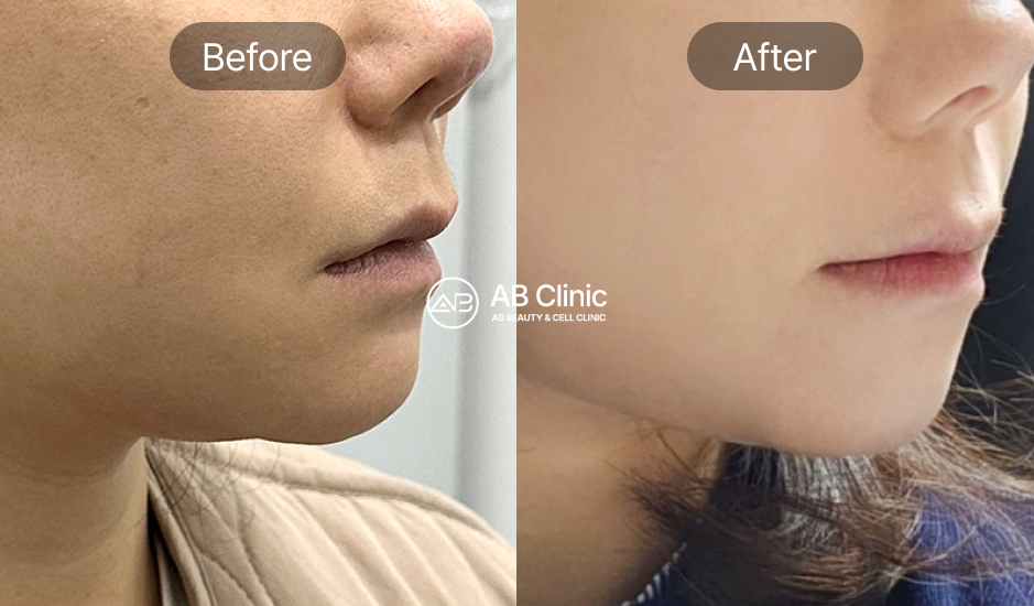 face-line-treatment-with-korean-beauty-treatments-before-and-after
