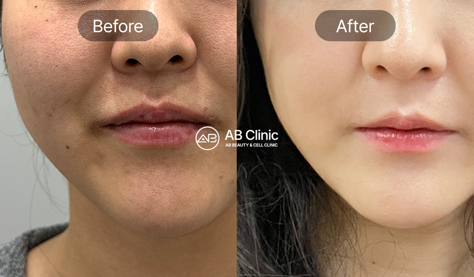 what-is-korean-cell-stem-therapy