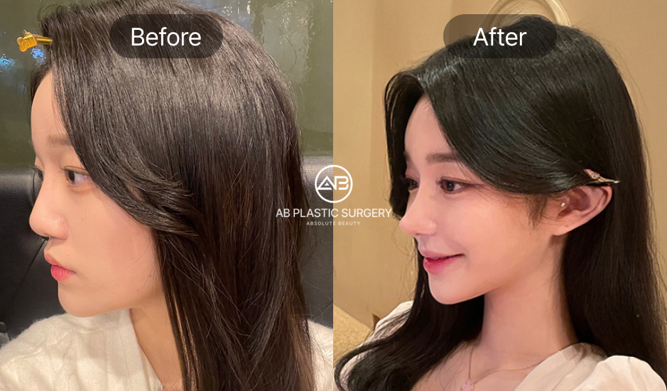 before and after aesthetic surgery in korea nose job rhinoplasty