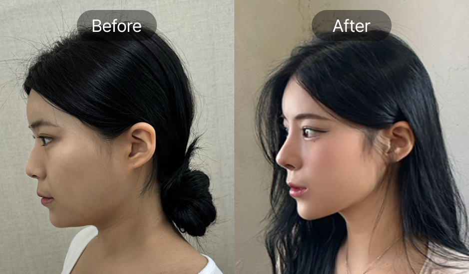 before and after aesthetic surgery in korea seoul