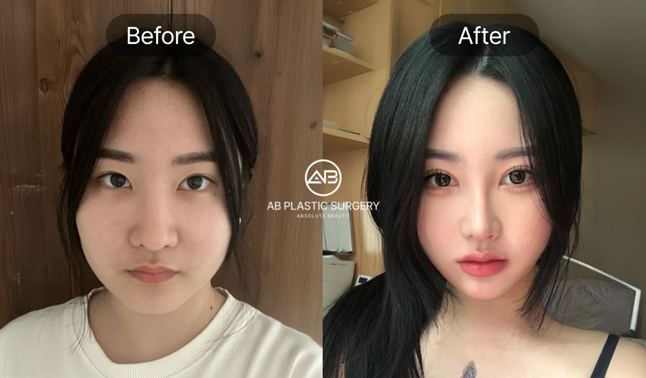 before and after nose job in seoul korea