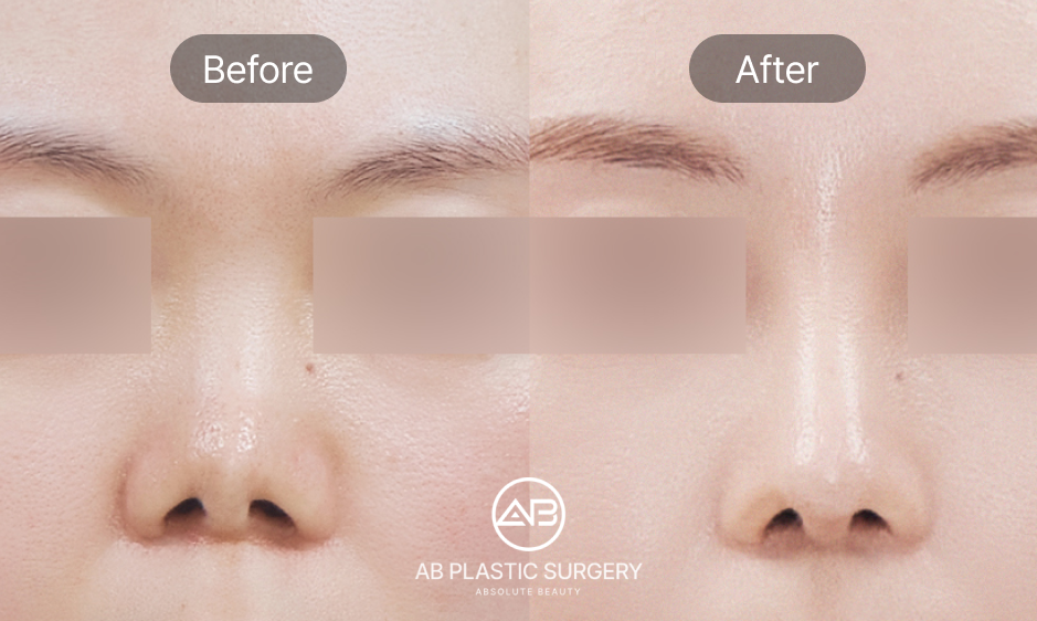before and after upturned nose correction in korea seoul