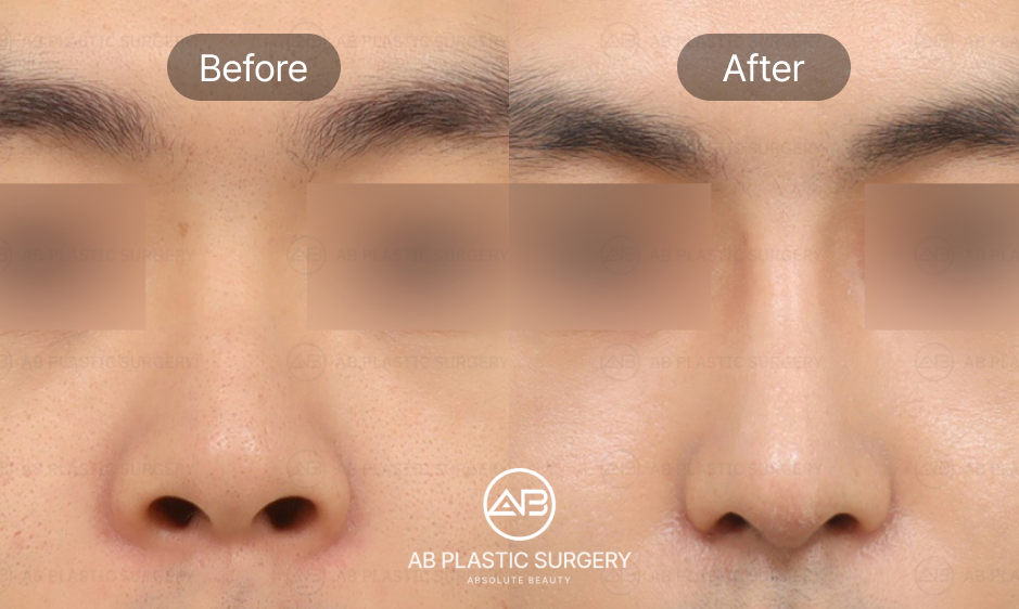 cases-when-upturned-nose-should-be-fixed