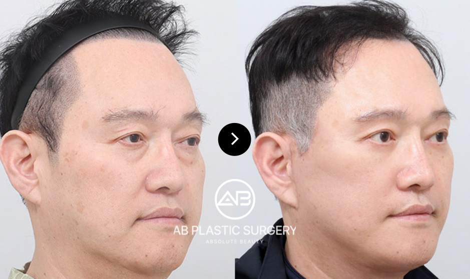 different types of ponytail lift which is best for you