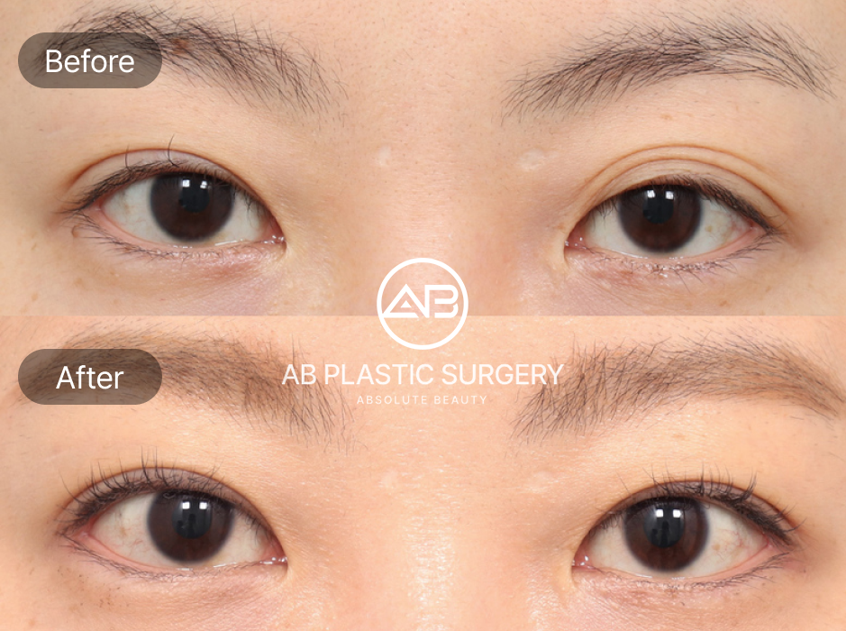 double eyelid surgery before and after korea seoul