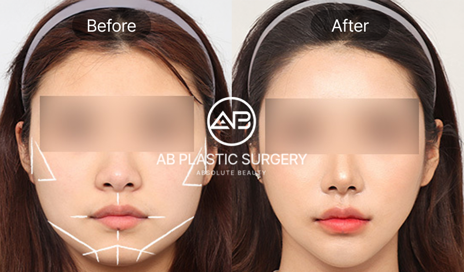 facial-countouring-aesthetic-surgery-in-korea-realistic-results