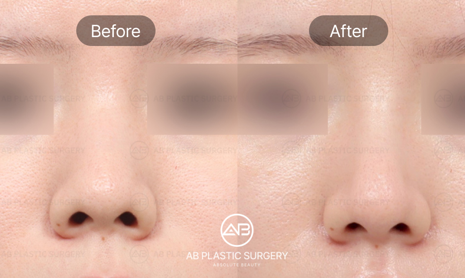 rhinoplasty for upturned nose correction