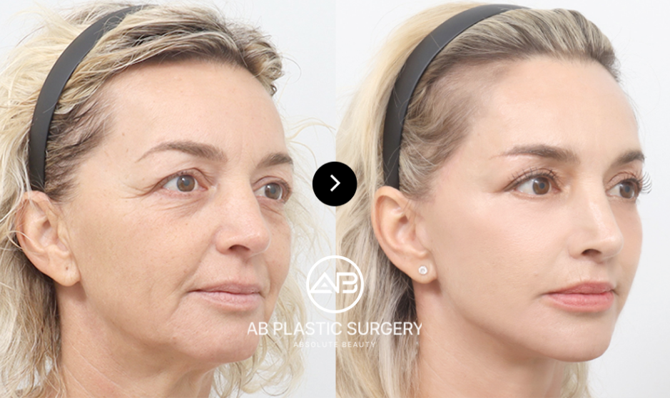 what is pony tail lift facial lift korea