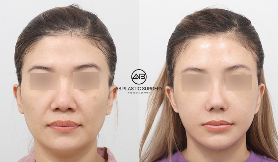 stem cell facial before and after results in South Korea