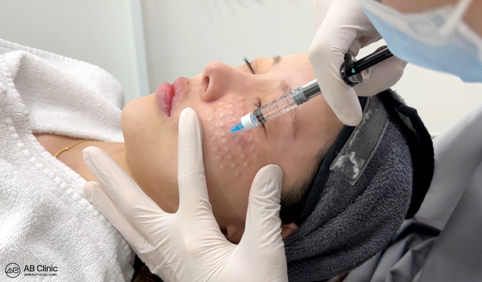Skin booster injection Korea, Rejuran Healer treatment, mesotherapy for skin rejuvenation, collagen stimulation therapy, personalized skin care clinic, anti-aging injection, Korean dermatology procedure, AB Plastic Surgery Korea, facial hydration treatment, non-surgical skin therapy