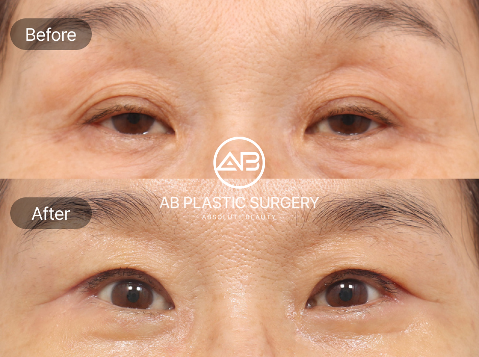 Upper Blepharoplasty in South Korea With Before And After Results And Effects