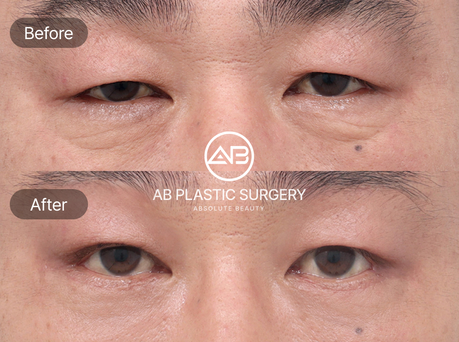 Upper And Lower Blepharoplasty Before And After in South Korea
