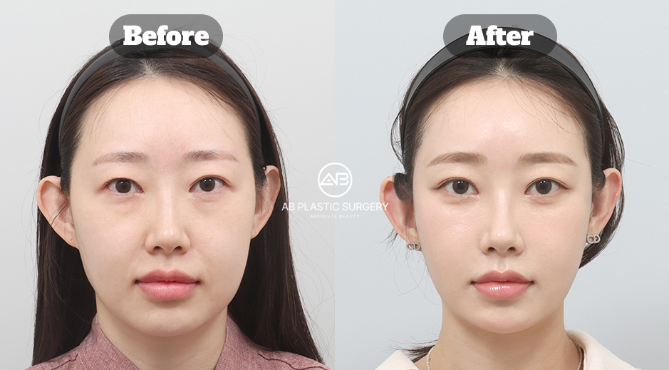 Before and after comparison image illustrating volume restoration and facial balance changes related to Ozempic face in South Korea
