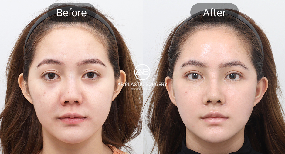 South Korea mini facelifting and face fat grafting before and after results photo