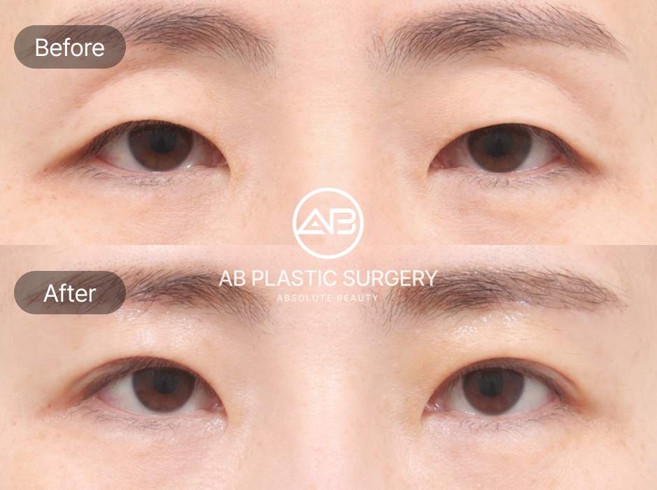 Before And After Results of Lower Blepharoplasty Surgical Techniques in South Korea