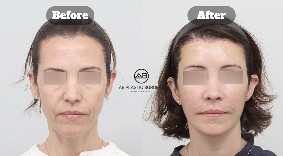 South Korea before and after photo of full SMAS facelift with Endotine forehead lift, neck lift, and facial fat grafting