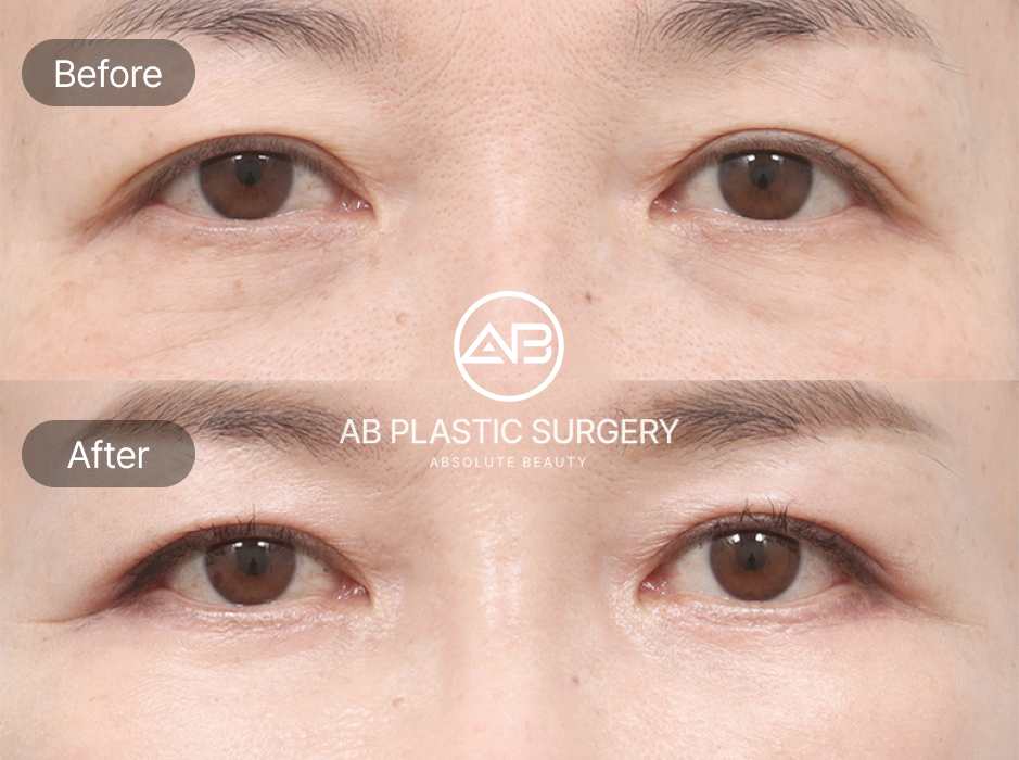 Lower Blepharoplasty Before And After Results for Under-Eye Bags