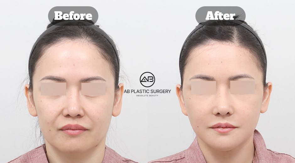 South Korea before and after photo of full SMAS facelift with neck lift, forehead lift, and facial fat grafting