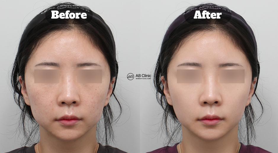 South Korea before and after photo of Potenza RF microneedling, skin booster treatment, and hyaluronic acid facial filler injections