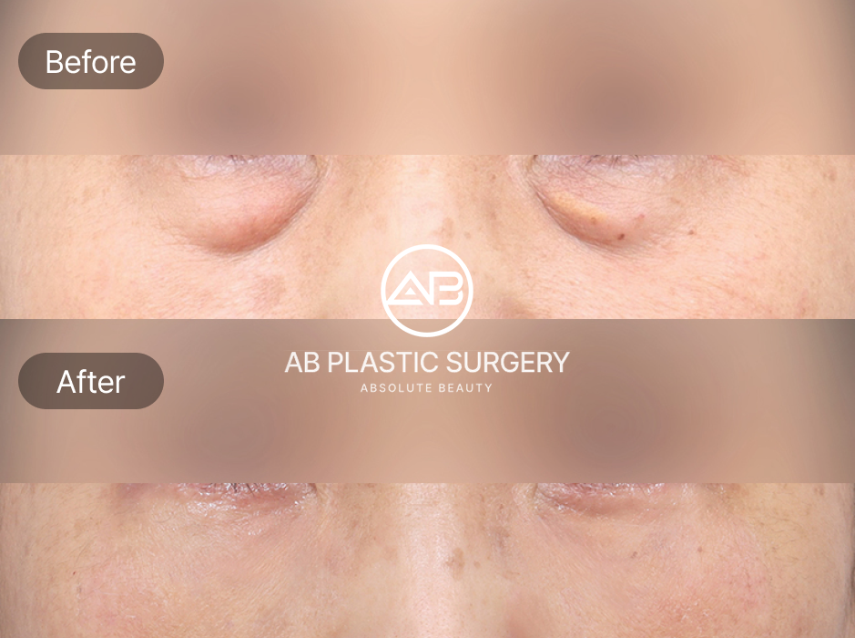 Before And After Results And Longevity of Lower Blepharoplasty in Korea