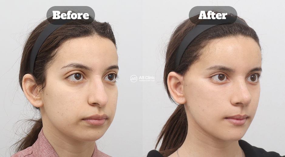 South Korea before and after photo of ponytail lifting combined with facial liposuction