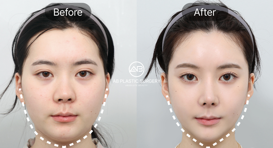 Before and After Facial Contour Surgery Results Showing Improved Jawline, Cheekbone Balance, and Chin Definition