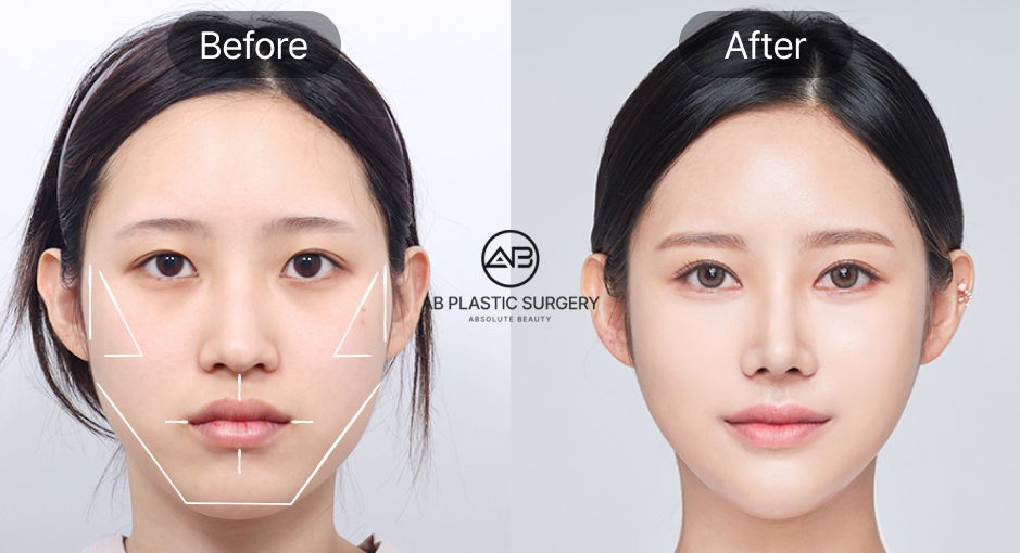 Real Patient Before and After Results of South Korea Facial Contouring and Cheekbone Reduction Surgery