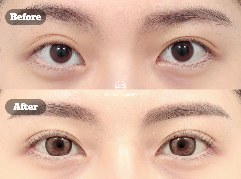 One Month After Non-Incisional Eyelid Correction and Lateral Canthoplasty
