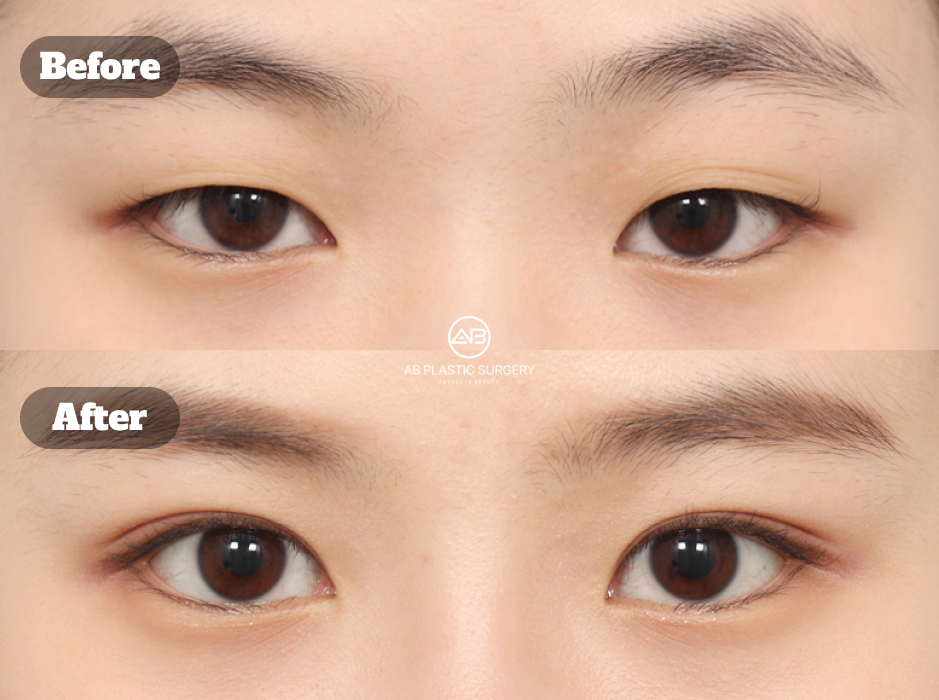 Non-Incisional Double Eyelid Surgery in Korea Before and After
