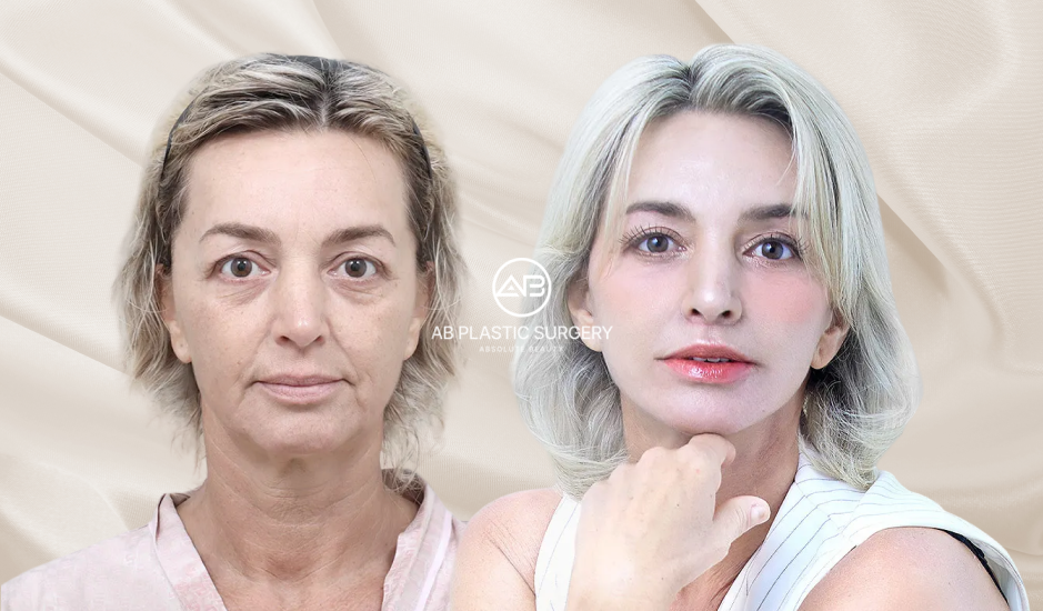 Skin Laxity Before and After Showing Facial Sagging and Loss of Elasticity