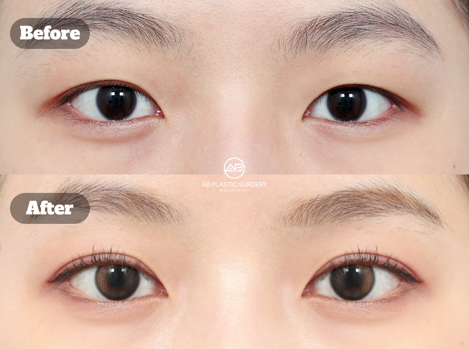 Patient Review of Double Eyelid Surgery in Korea Before and After