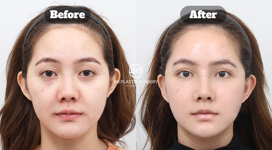 Mini Facelift Before and After Photo in Korea