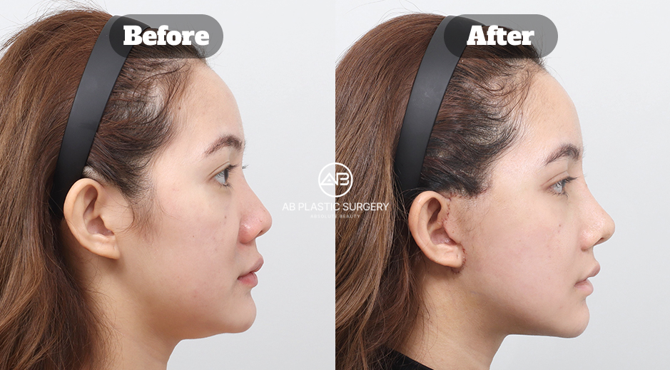 Mini Facelift Surgery Before and After Review in Korea