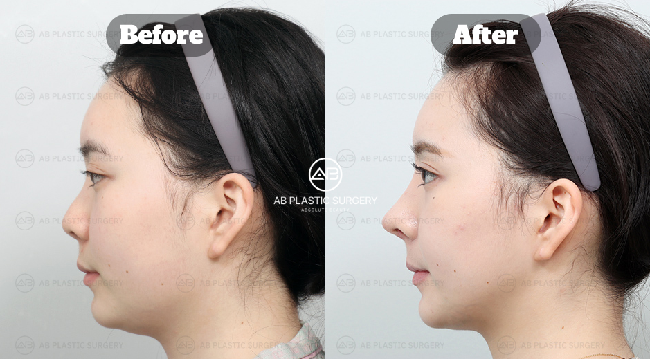 Low nose rhinoplasty procedure designed to enhance nasal height and balance