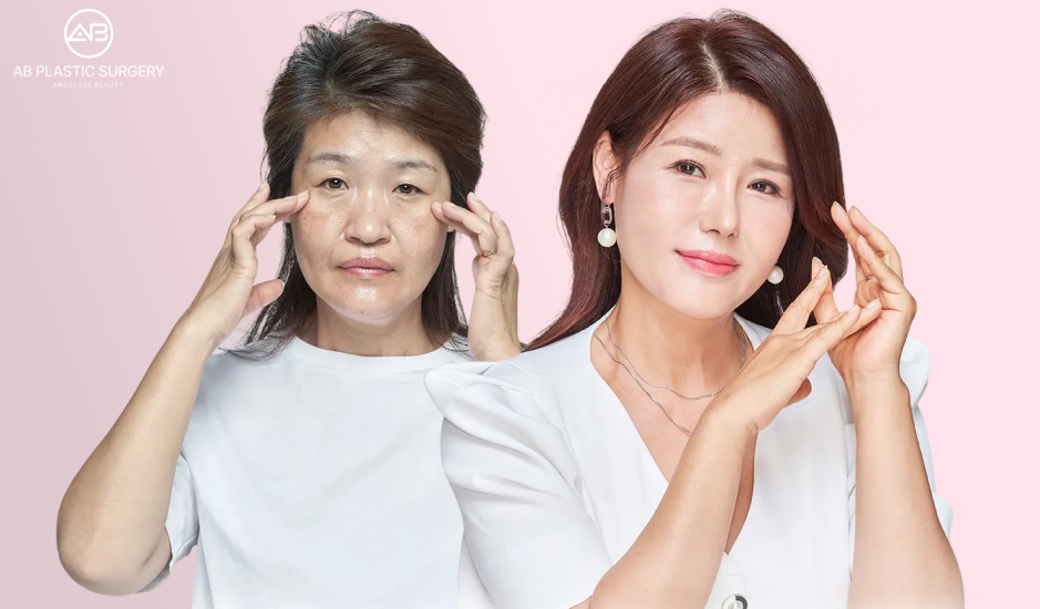 Before and after comparison of surgical Endotine lift showing midface and cheek lifting results